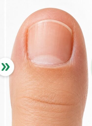 Healthy nail after 12 weeks of FungaBeam Pen use